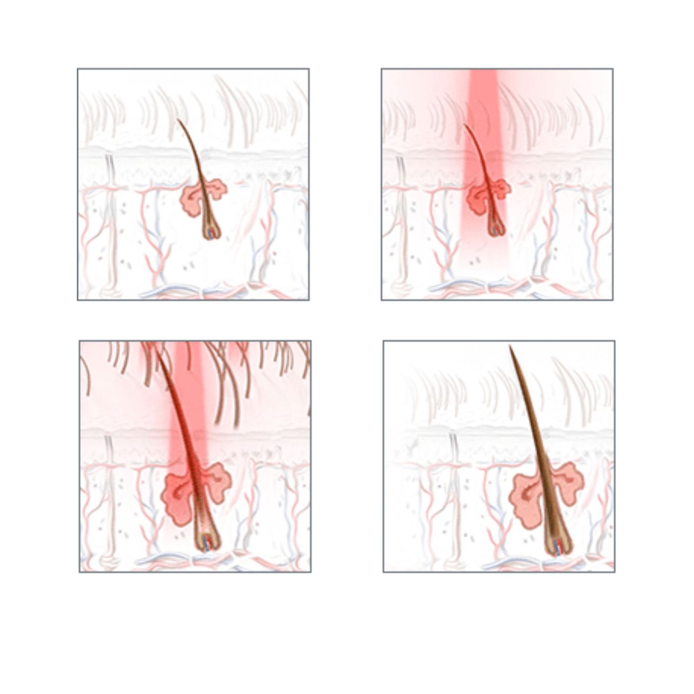 Capillus Laser therapy cap results