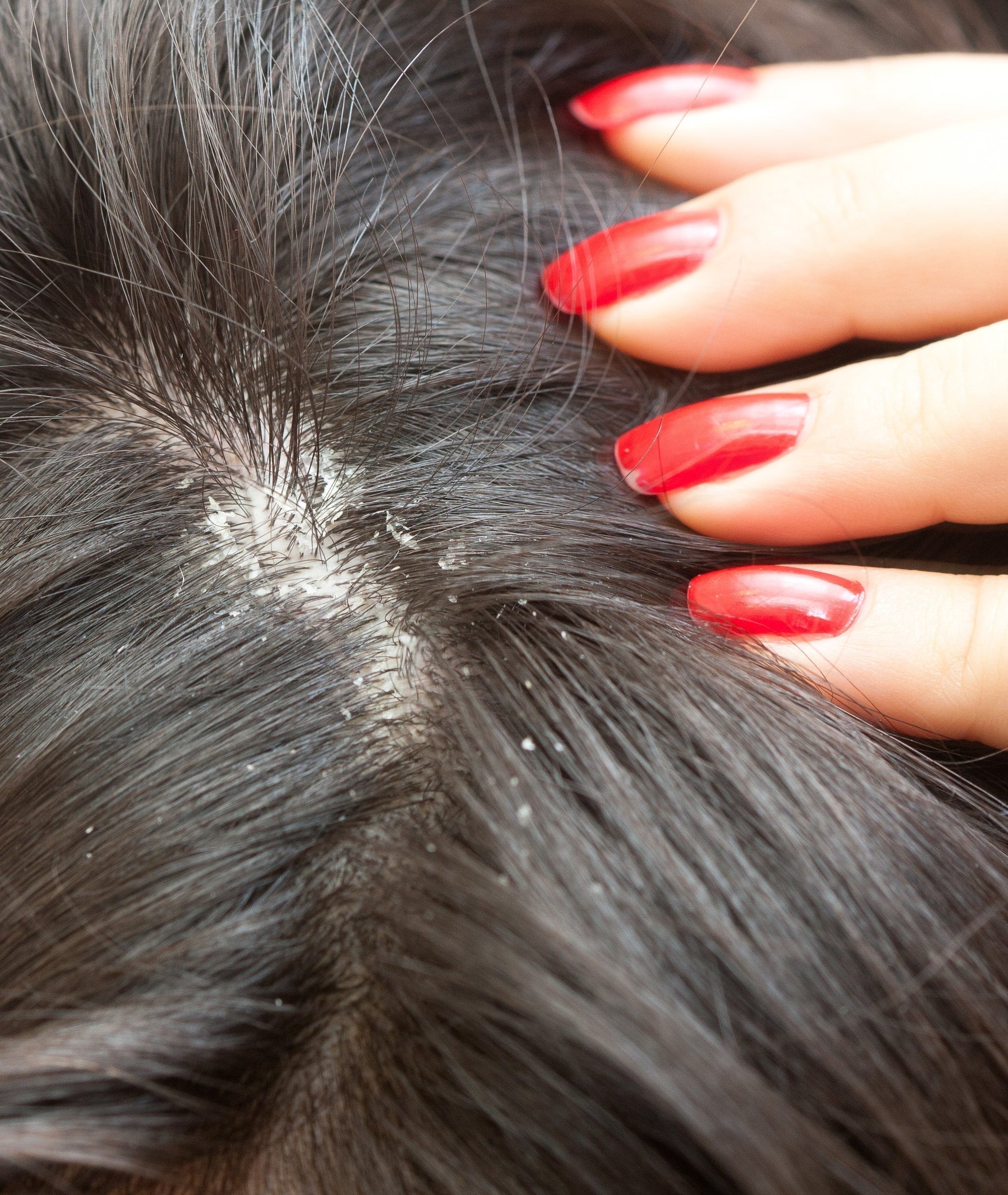 How to Get Rid of Dry Dandruff: 4 Effective Tip