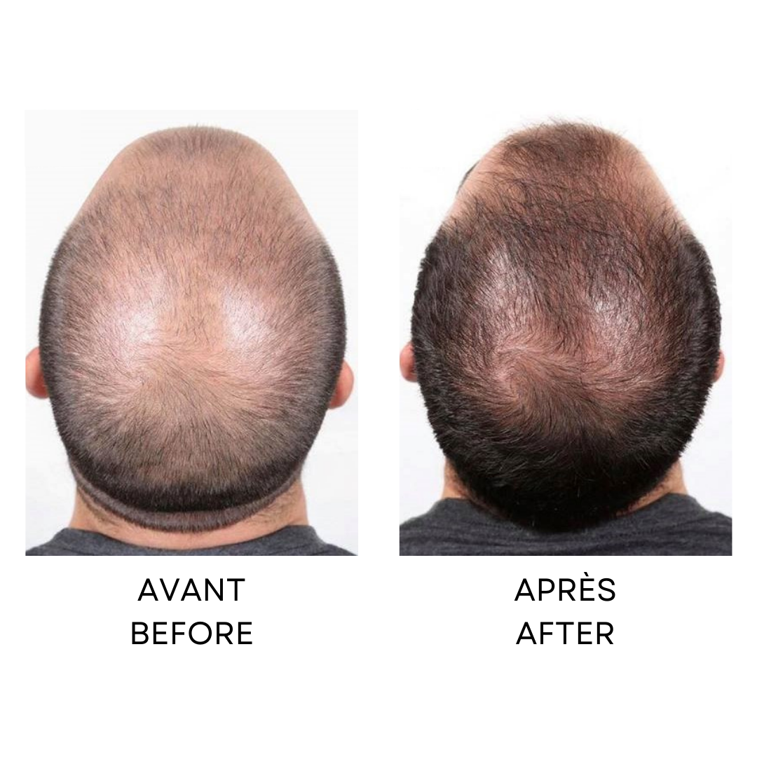 Capillus Before and After results on male pattern baldness