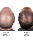 Capillus Before and After results on male pattern baldness