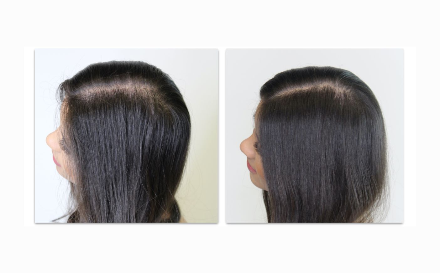 Before and after capillus laser therapy in women