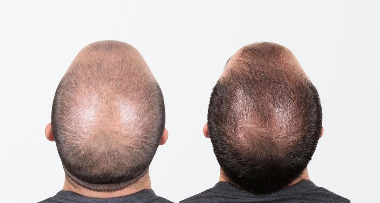 Before and After Capillus Laser Therapy Cap in men with Male Pattern Baldness