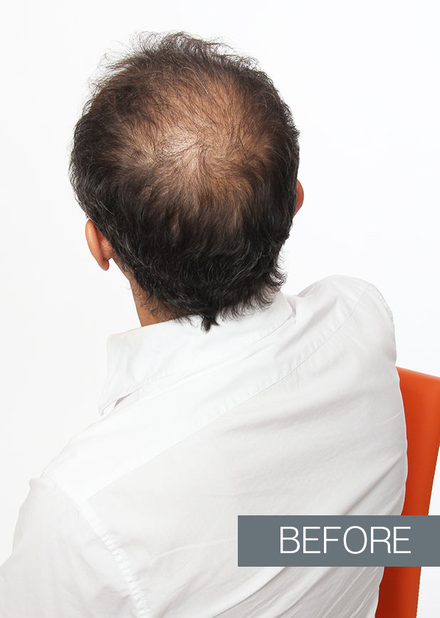 Kamitek Hair microfibers on man with baldness